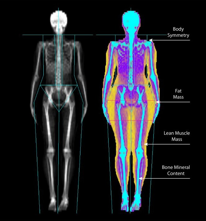 Bentetthetsmåling (DEXA) i Oslo